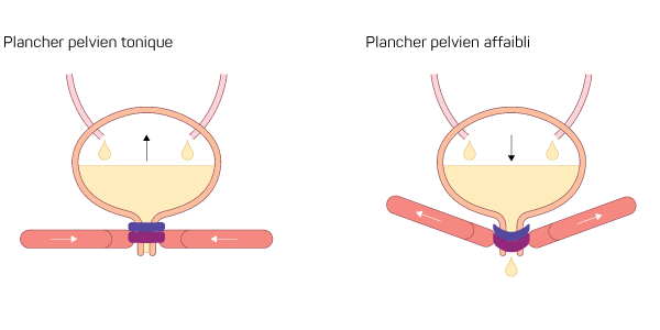 Schéma expliquant la différence entre un plancher pelvien tonique et un plancher pelvien affaibli