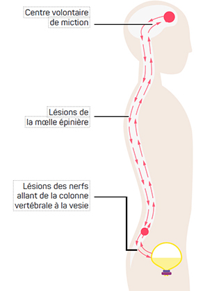 Schéma illustrant les causes de l'incontinence réflexe.
