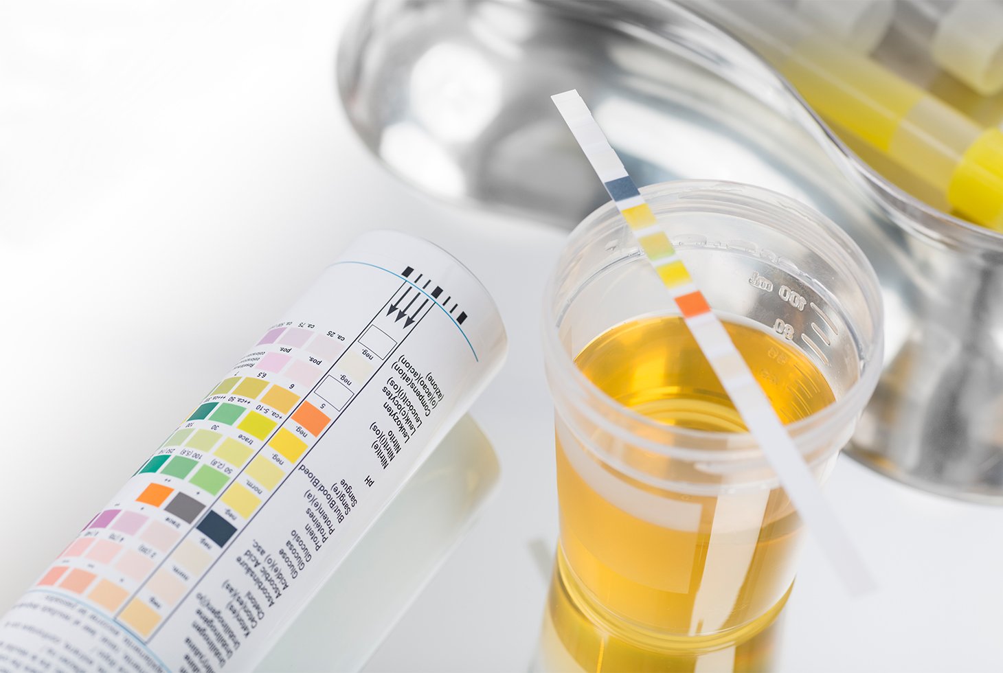 Visuel d’un échantillon d’urine analysé en laboratoire. Un prélèvement effectué dans le cadre d’une analyse urinaire